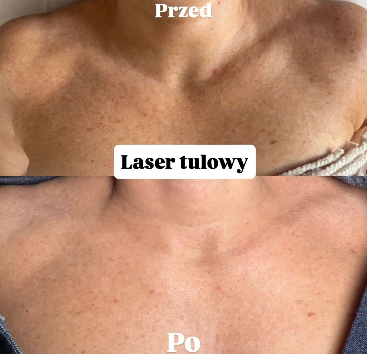 Laser tułowy — dekolt przed i po zabiegu w holi studio