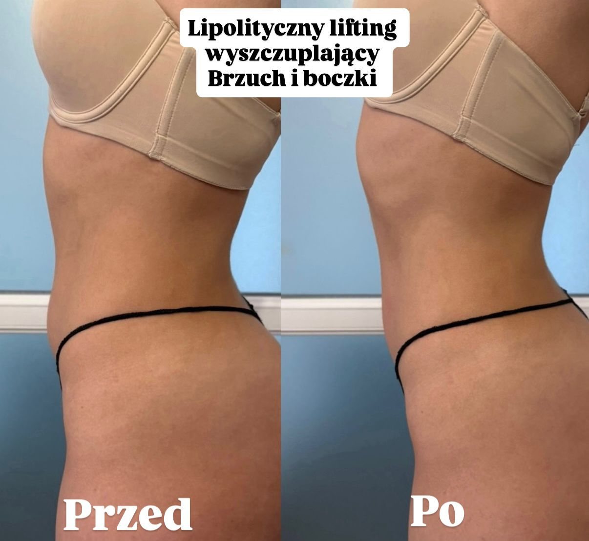 Modelowanie brzucha falą radiową — holi studio Bydgoszcz