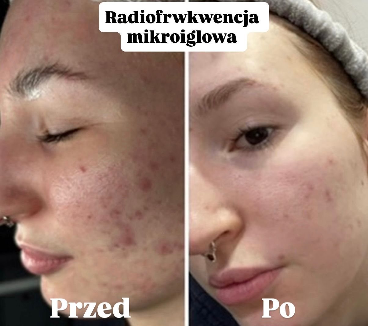 RF Mikroigłowa — holi studio Bydgoszcz